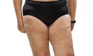 trattamento del lipedema con la fisioterapia